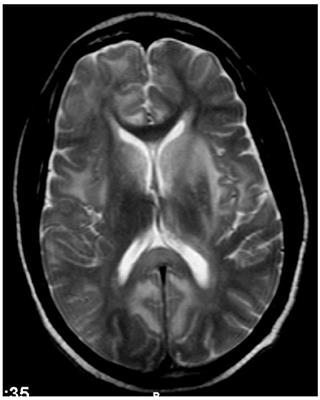 HIV-Associated CD8 Encephalitis: A UK Case Series and Review of Histopathologically Confirmed Cases